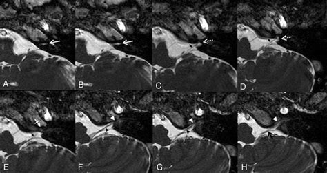 Axial D Bffe Images Of The Lower Cranial Nerves From The Level Of The