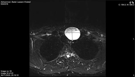 Adult Cervical Thymic Cysts A Narrative Review Hesham Saleh Almofada