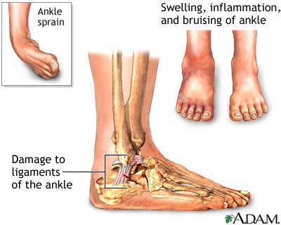 ANKLE PAIN INFORMATION: WHAT IS ANKLE PAIN?