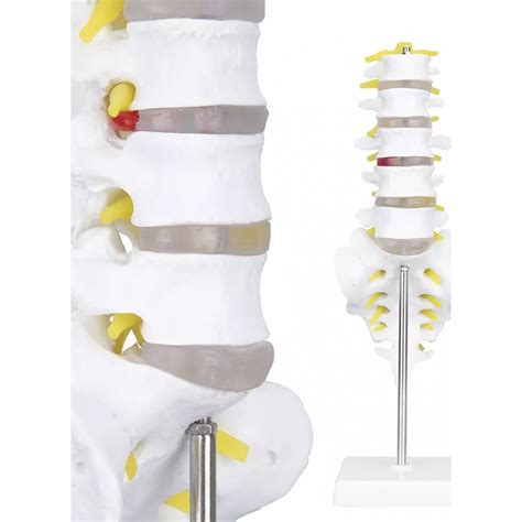 Lumbar Vertebrae With Sacrum Coccyx And Herniated Disc Life Size