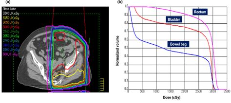 The Isodose Curves For The Radiation Plan On The Planning Computed Download Scientific Diagram