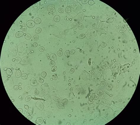 Epithelial Cell In Urine