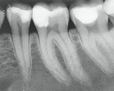 Incappucciamento Diretto Della Polpa Dentale Libri Odontoiatria