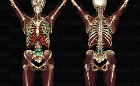 3D CT scan of metastatic bone cancer – Stockphoto