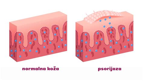 Psorijaza Herba Svet