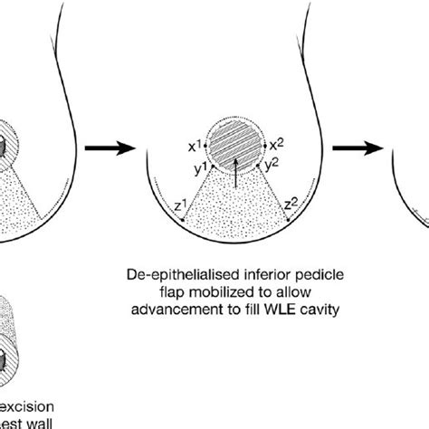 Extended Superior Pedicle With Transposition Of The Inferior Download Scientific Diagram