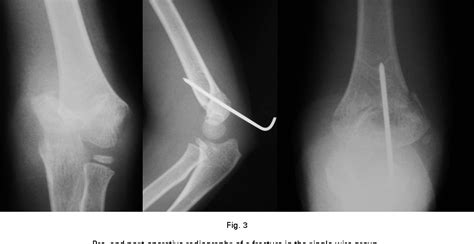 Figure 1 From Posterior Intrafocal Pinning For Extension Type