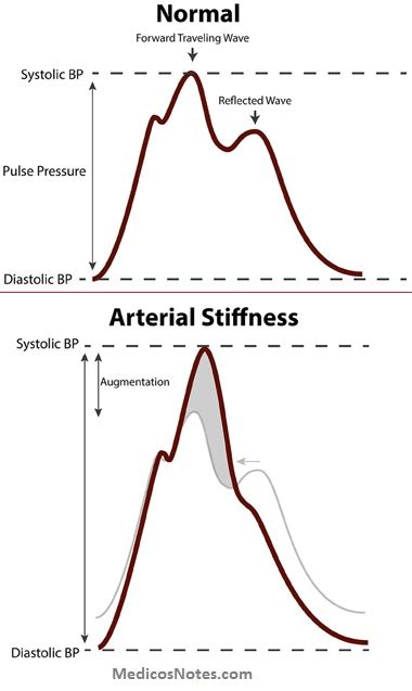 Carotid Pulse Wave