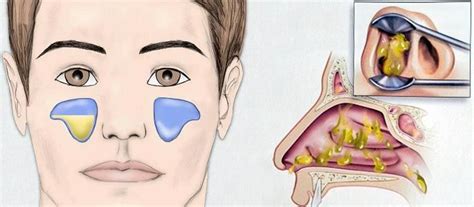 Выделения при экссудативном виде гайморита | Nose problems, Disney ...