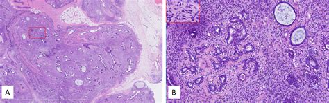 Frontiers Imaging Features Of Breast Periductal Stromal Tumor A Case