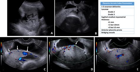 The Placenta Accreta Index: Do more ultrasound variables add value ...