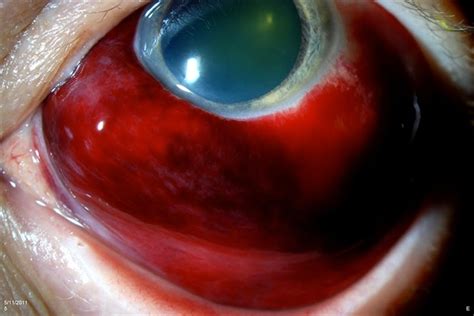 Conjunctiva Hemorrhage