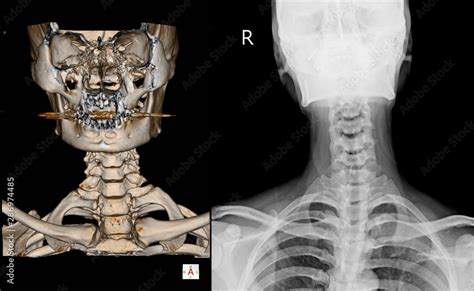 Ct Scan Cervical Spine D Render And X Ray C Spine Finding Reverse