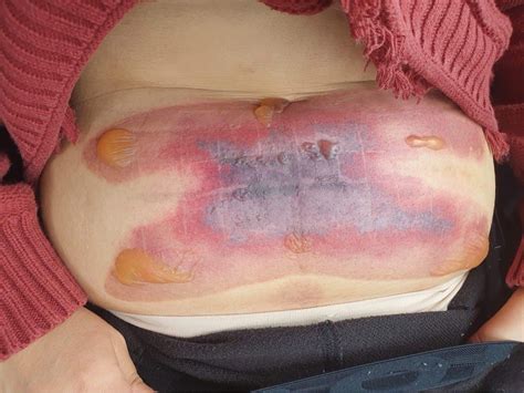 Severe Abdominal Fat Necrosis Following Complications Of Cryolipolysis