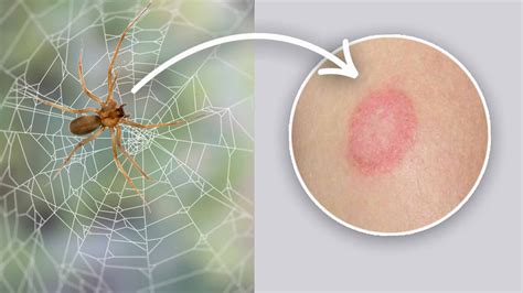 15 Types Of Spider Bites Identification Chart With Picture