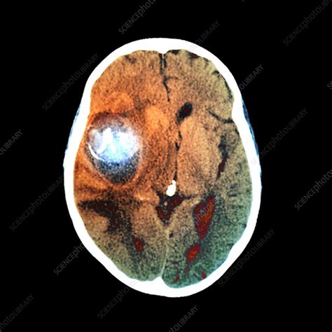 aneurysm ct scan stock image  science photo library