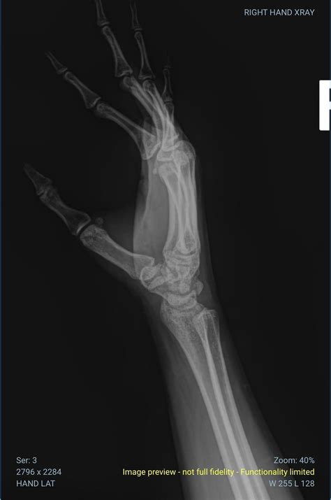 distal radius fracture : r/xrays