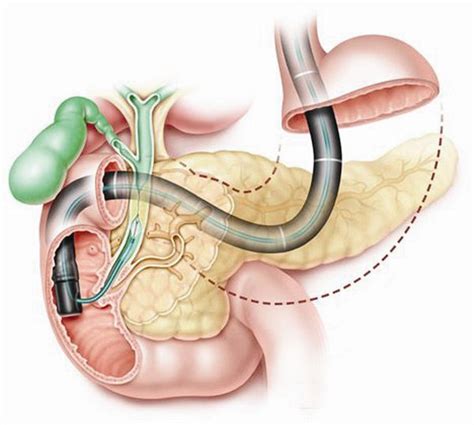 Endoscopic Retrograde Cholangiopancreatography ERCP Procedure North