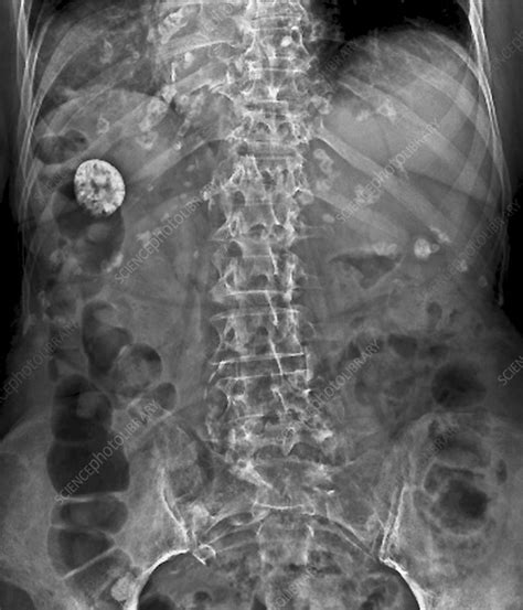 Gallbladder Stones Xray