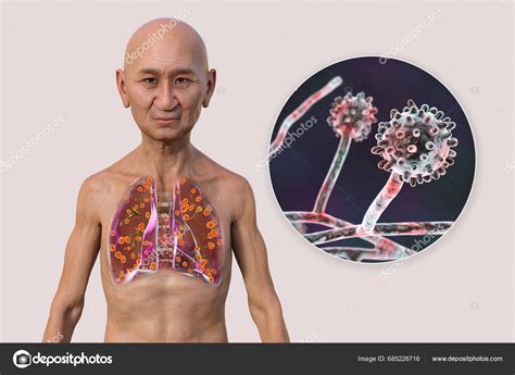 Lung Histoplasmosis Fungal Infection Caused Histoplasma Capsulatum