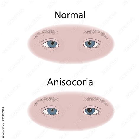 Anisocoria in infants, child, kid, pupils of different sizes. Vector ...