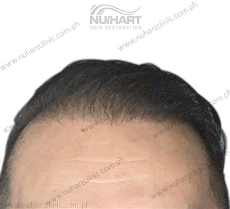 Final Before And After Sliding1 Nuhart Hair Restoration Philippines