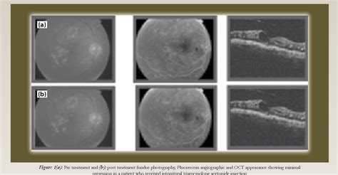 Figure 1 From Intravitreal Monotherapy With Bevacizumab And Triamcinolone Versus Combination