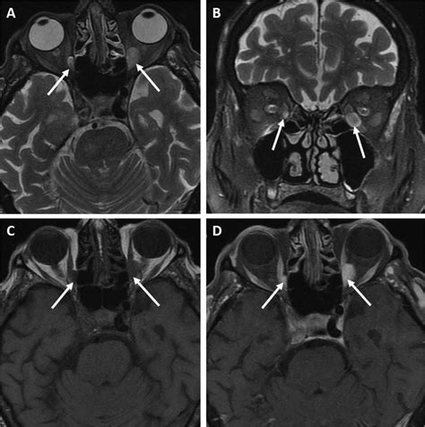 MRI Examination Axial A And Coronal T2 Weighted FATSAT B Images