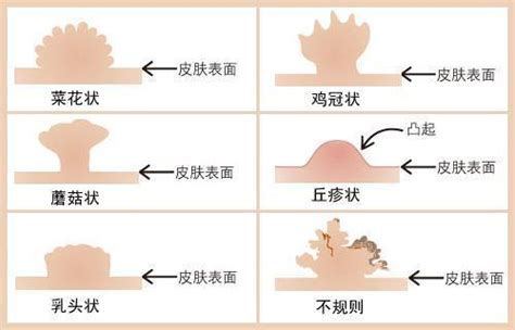 尖銳濕疣最開始長什麼樣 壹讀