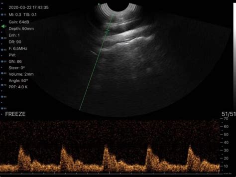 Transvaginal Ultrasound Scanner Color Doppler Sifultras