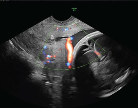 Transvaginal Ultrasound Image At 16 Weeks Showing Vasa Previa Download Scientific Diagram