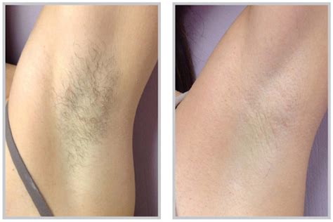 Laser Hair Removal Underarm Before And After