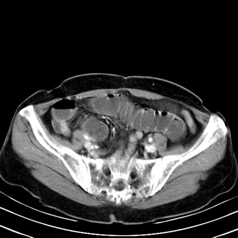 Radiopaedia Case Femoral Hernia Causing Small Bowel Obstruction Id