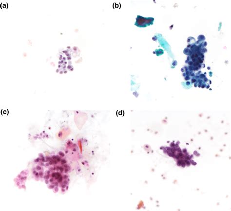 Urine Cytology In The Detection Of Renal Cell Carcinomas A Territory