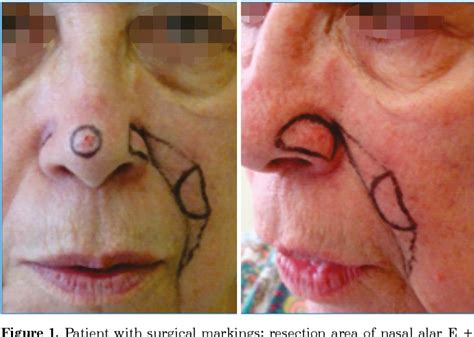 Figure 1 From Nasolabial Interpolation Flap For Nasal Alar