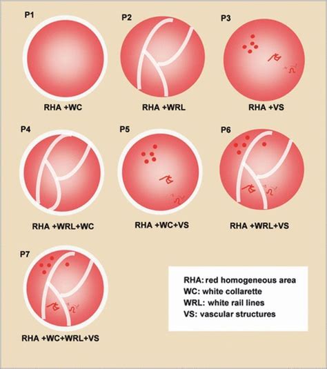 Schematics Of The Exclusive Dermoscopic Patterns In Pyogenic