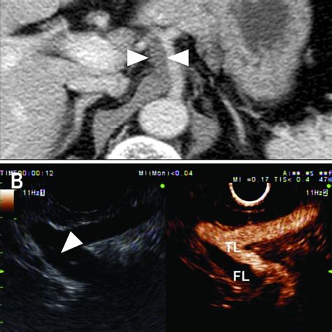 Computed Tomography Ct And Endoscopic Ultrasound Eus Findings In Download Scientific