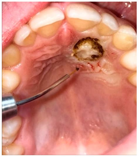 How Long Does Impacted Canine Surgery Take