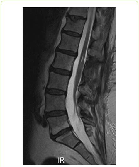 Sagittal T2 Weighted Mr Image 8 Months After Surgery A Small Download Scientific Diagram