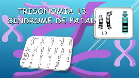 Trisomía 13 Síndrome de Patau Lupe Olvera uDocz