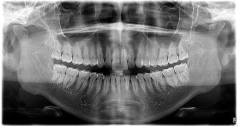 Visibly with retrognathism but teeth in class 3 malocclusion, why? : r ...