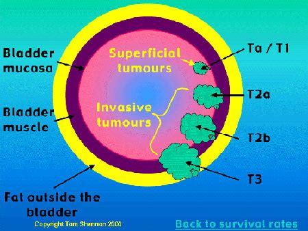 Transitional cell bladder cancer symptoms and treatment | myVMC