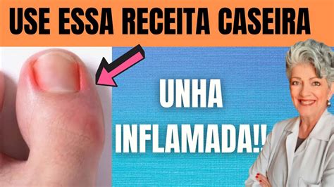 REMÉDIO CASEIRO Para UNHA INFLAMADA YouTube