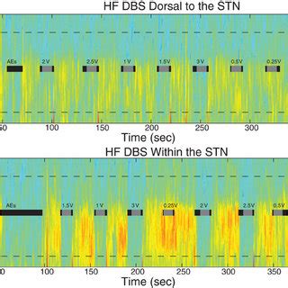 Diffusion Tensor Imaging Used To Guide Ecog Strip Placement A B