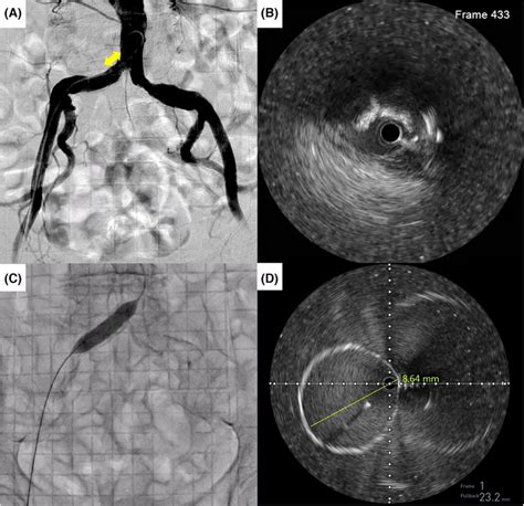 Fluoroscopic And Ivus Images During Evt Procedure A Aortography