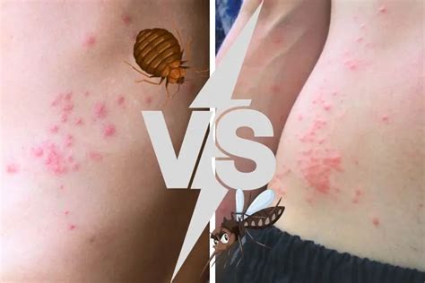 How To Distinguish Bed Bug Bites Vs Mosquito Bites Expert Tips