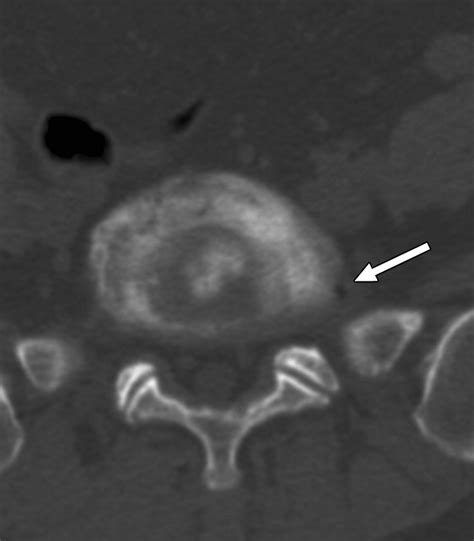 Mr Diskography And Ct Diskography With Gadodiamideiodinated Contrast