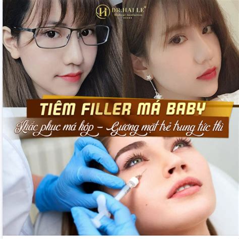 TiÊm Filler MÁ Baby TẠo HÌnh KhuÔn MẶt TrẺ Trung Thu HÚt MỌi Ánh NhÌn