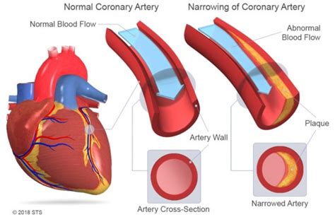 Esa D Views Of A Normal Artery Versus A Narrowed Artery