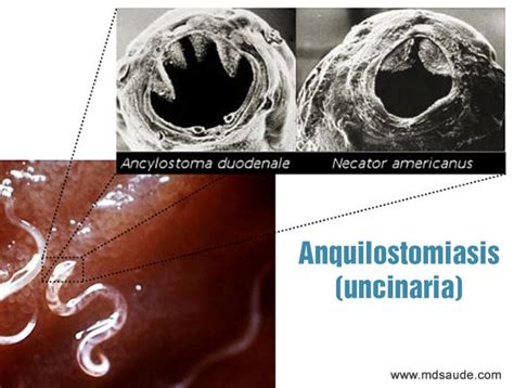 Anquilostomiasis Uncinaria Qué Es Síntomas Y Tratamiento